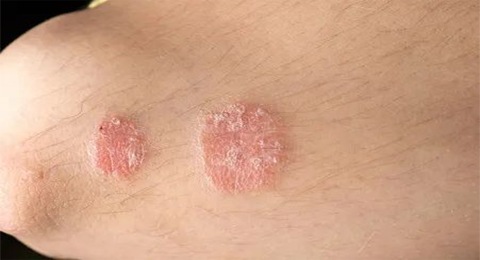 “牛皮癣”是什么原因引起的？能治好吗